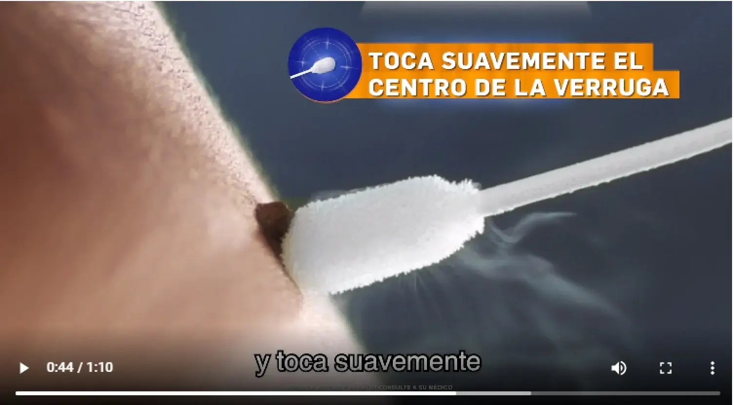 Pointts Elimina verrugas de forma fácil, segura y en casa